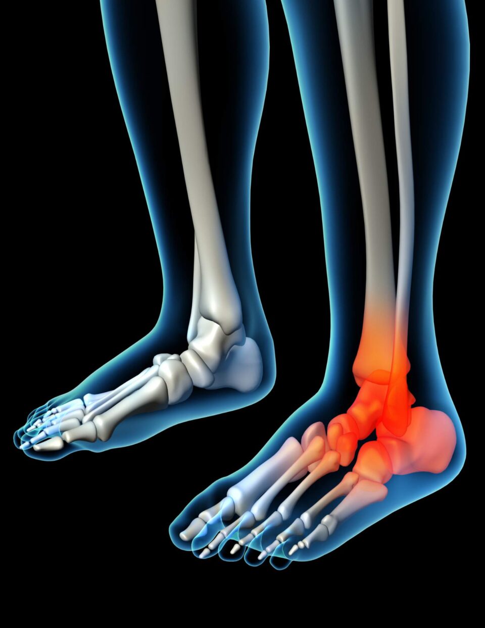 A person's foot is shown with a broken bone.