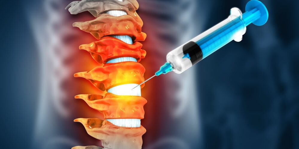 A syringe injects fluid into an inflamed spinal column, highlighting red and orange areas likely representing pain or inflammation. A syringe injects fluid into an inflamed spinal column, highlighting red and orange areas likely representing pain or inflammation form a spinal compression fracture.