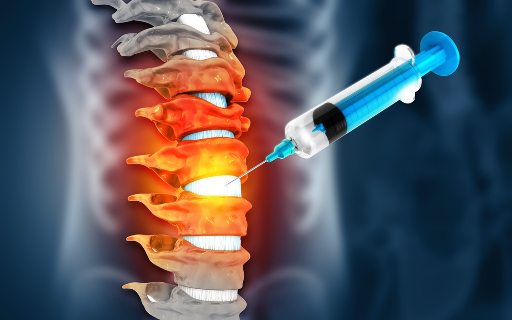 A syringe injects fluid into an inflamed spinal column, highlighting red and orange areas likely representing pain or inflammation. A syringe injects fluid into an inflamed spinal column, highlighting red and orange areas likely representing pain or inflammation form a spinal compression fracture.